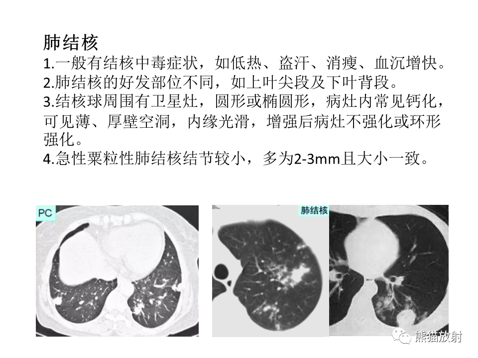 影像PPT - 【病例】肺隐球菌病2例CT影像-40