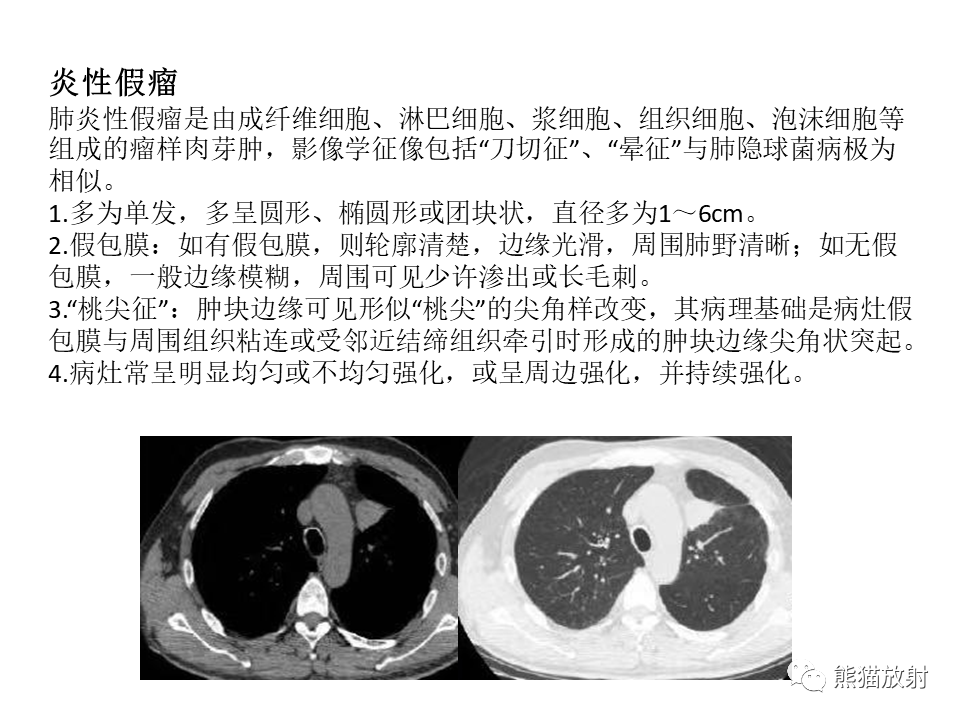 影像PPT - 【病例】肺隐球菌病2例CT影像-41