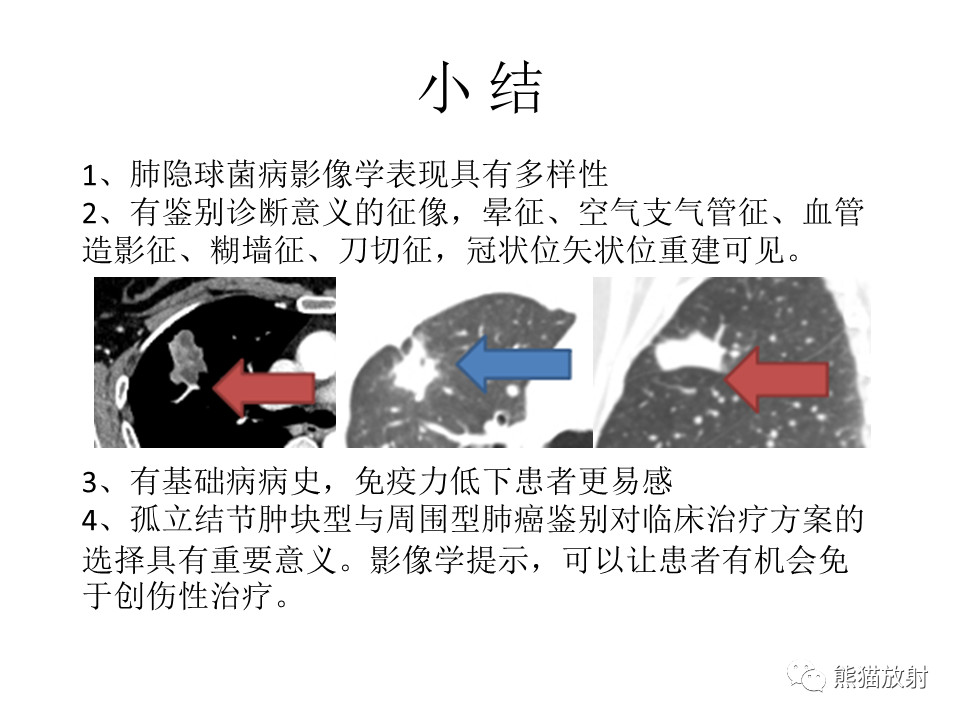 影像PPT - 【病例】肺隐球菌病2例CT影像-43
