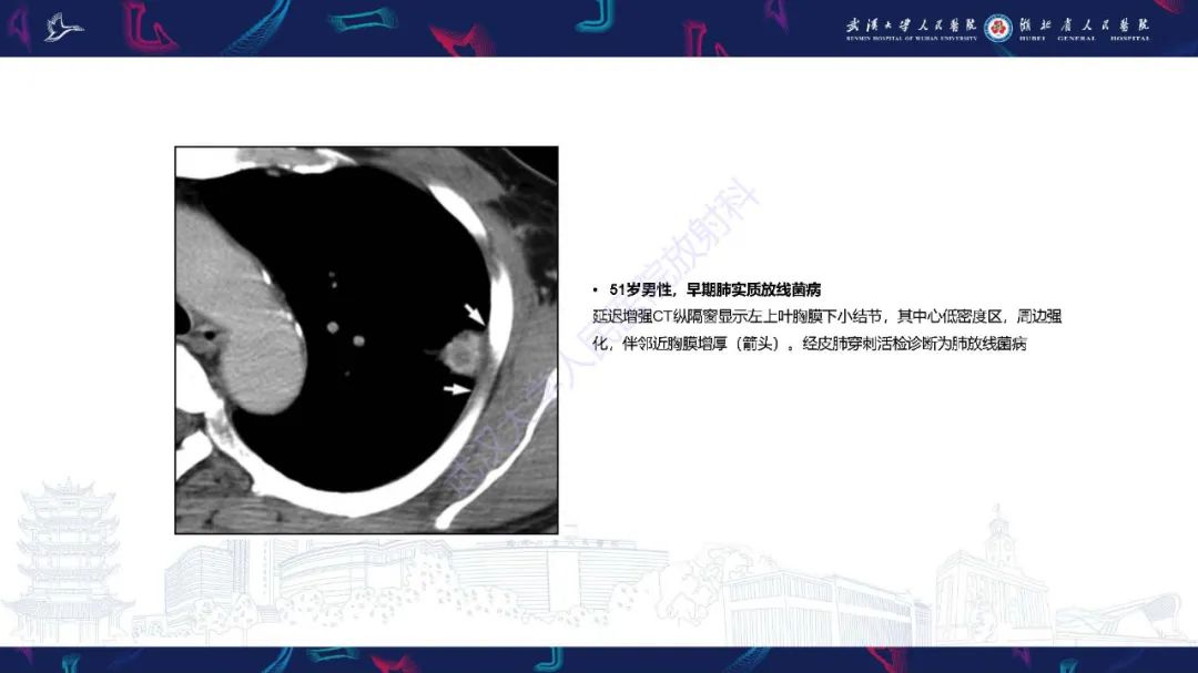 影像PPT - 【PPT】胸部放线菌病CT诊断-6