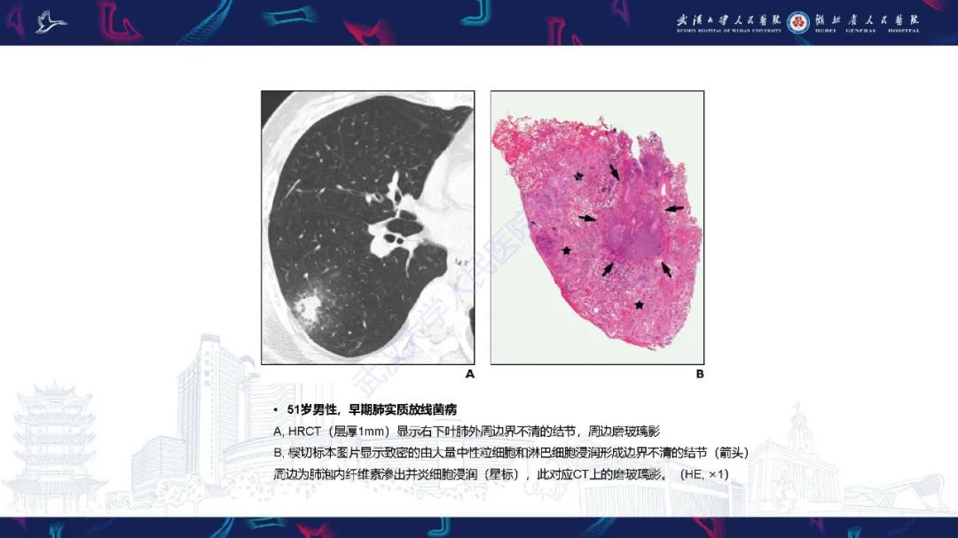 影像PPT - 【PPT】胸部放线菌病CT诊断-5