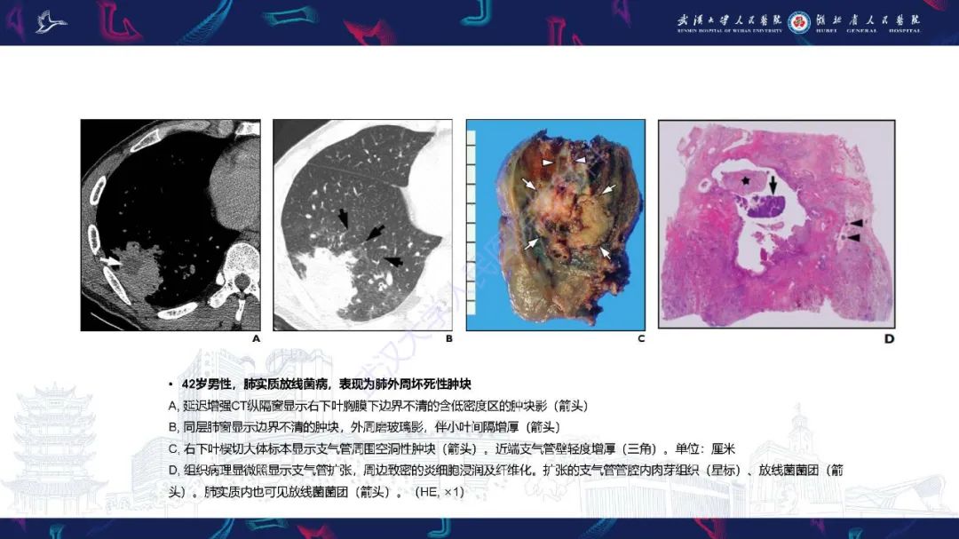 影像PPT - 【PPT】胸部放线菌病CT诊断-8