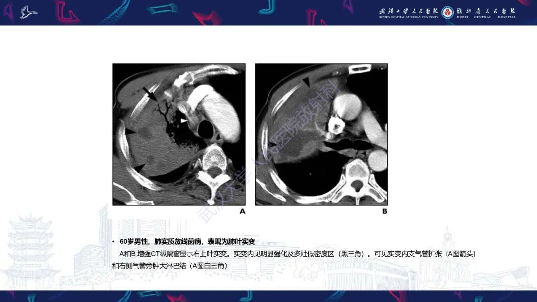 影像PPT - 【PPT】胸部放线菌病CT诊断-9