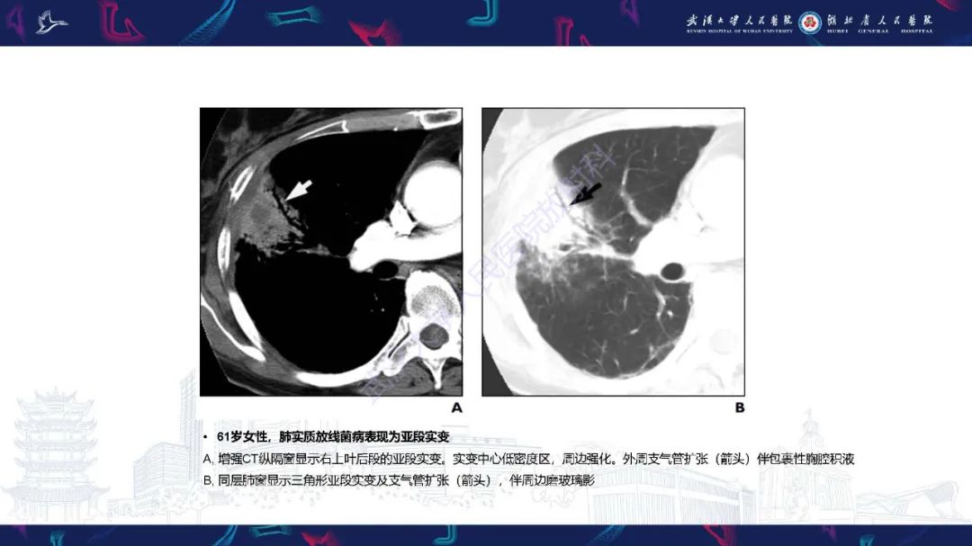 影像PPT - 【PPT】胸部放线菌病CT诊断-7