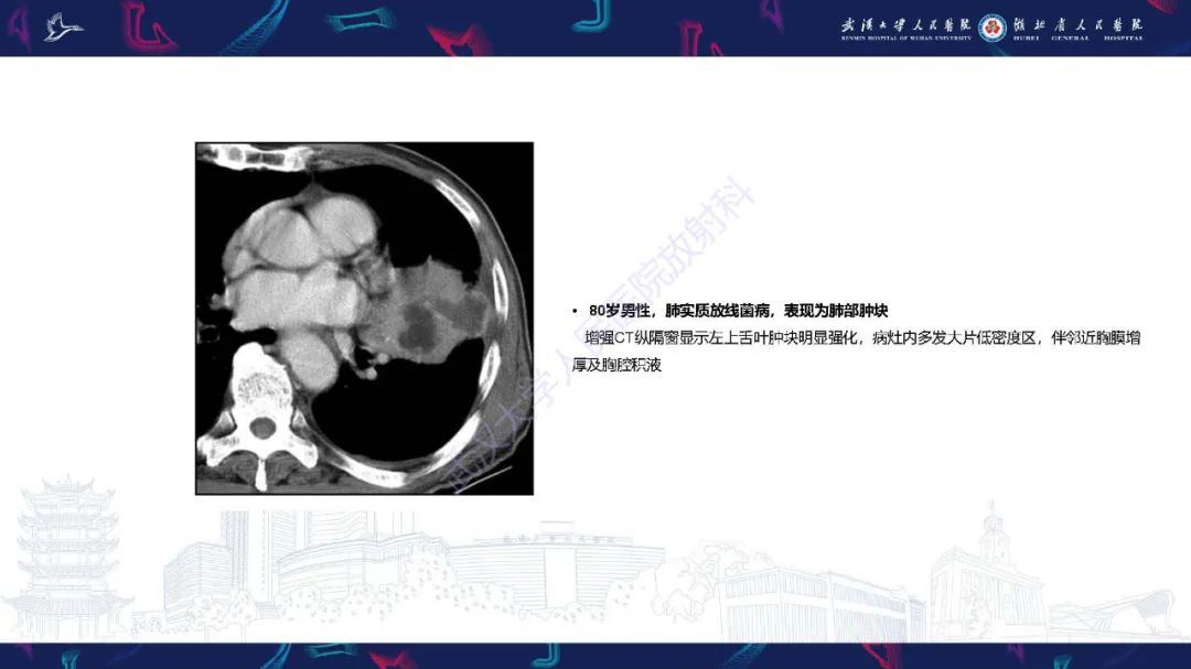 影像PPT - 【PPT】胸部放线菌病CT诊断-10