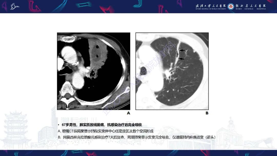 影像PPT - 【PPT】胸部放线菌病CT诊断-11