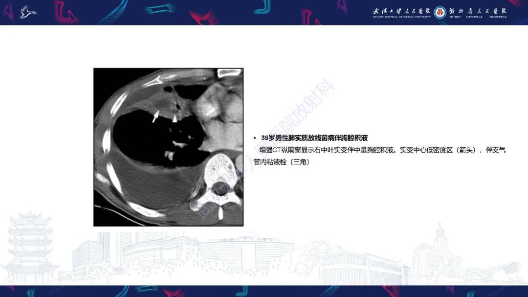 影像PPT - 【PPT】胸部放线菌病CT诊断-14