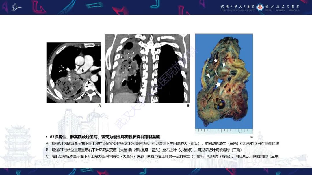 影像PPT - 【PPT】胸部放线菌病CT诊断-15