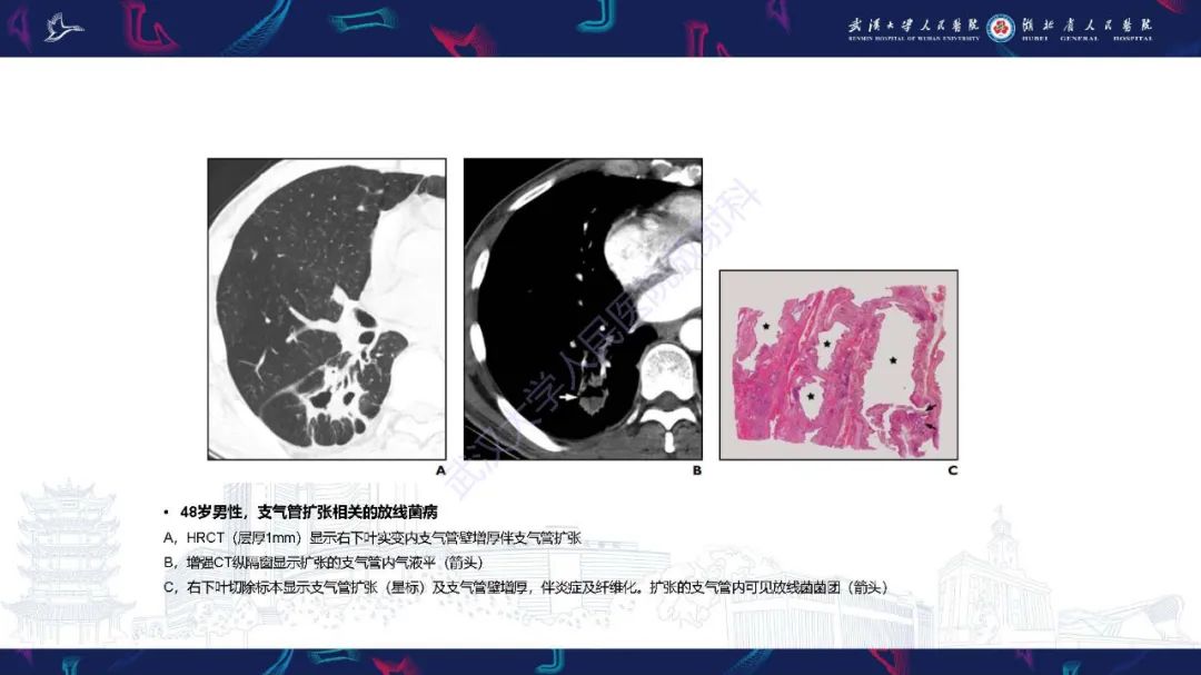 影像PPT - 【PPT】胸部放线菌病CT诊断-17