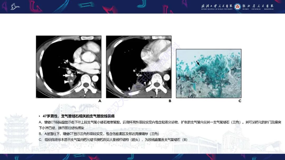 影像PPT - 【PPT】胸部放线菌病CT诊断-21