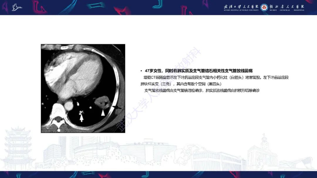 影像PPT - 【PPT】胸部放线菌病CT诊断-24