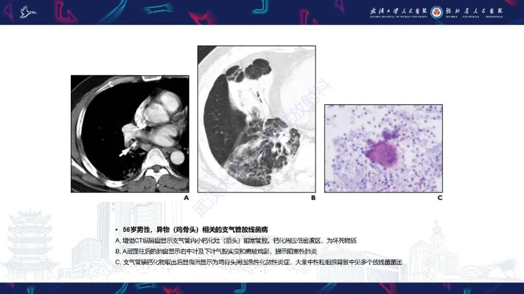 影像PPT - 【PPT】胸部放线菌病CT诊断-23