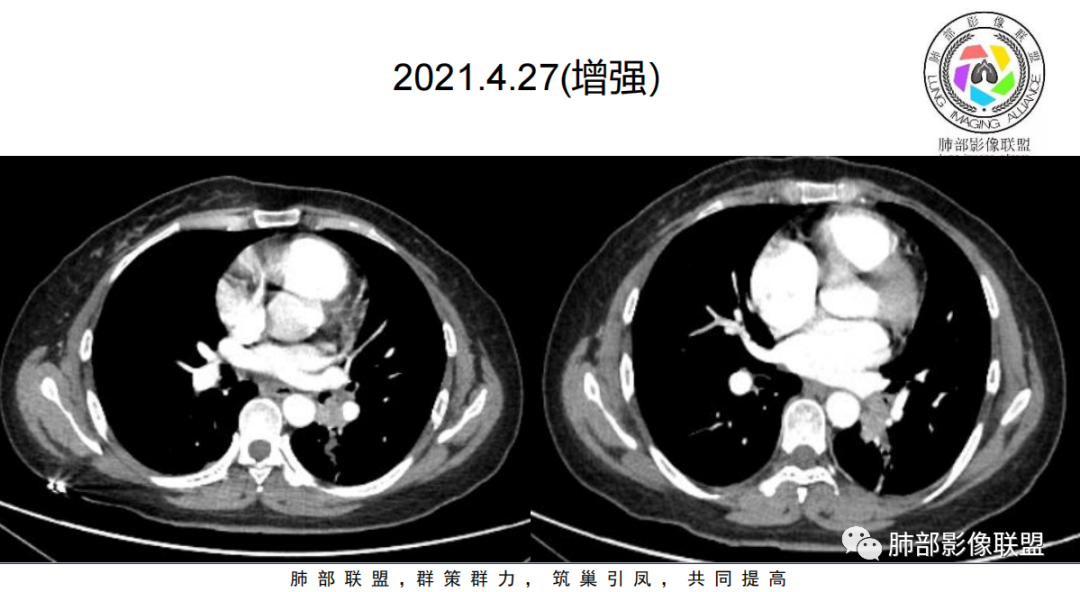 影像PPT - 【病例】青年女性的支气管阻塞—类癌1例CT影像-10