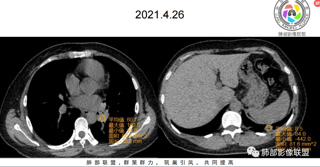影像PPT - 【病例】青年女性的支气管阻塞—类癌1例CT影像-9