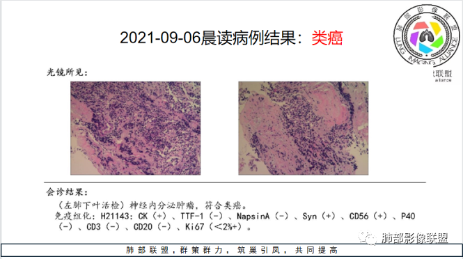 影像PPT - 【病例】青年女性的支气管阻塞—类癌1例CT影像-20