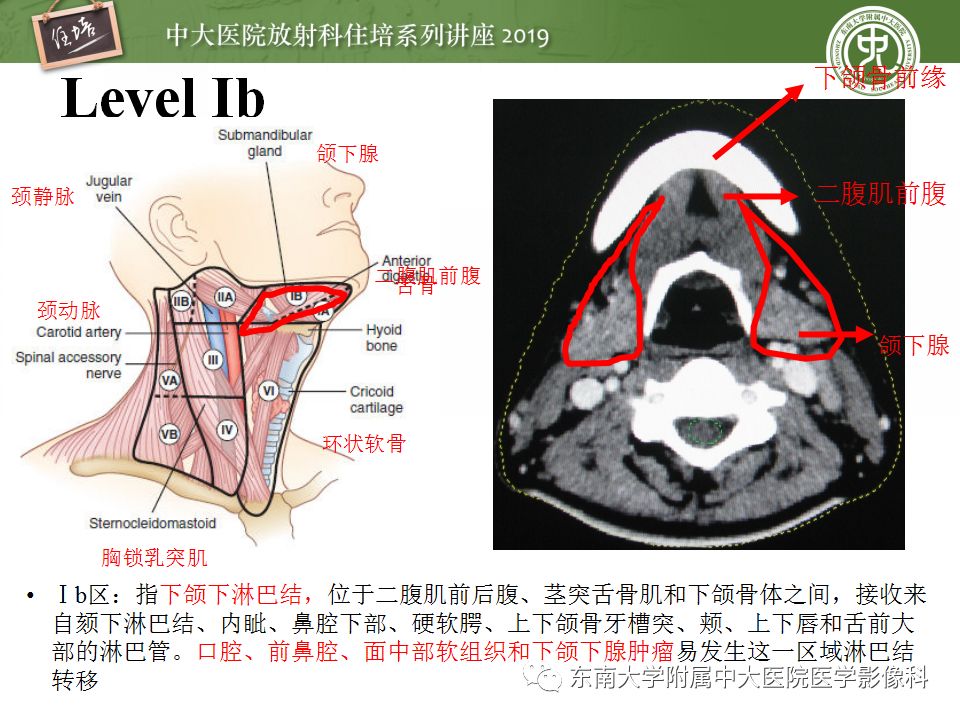 影像PPT - 【PPT】颈部淋巴结的影像解剖及常见病变的影像表现-9