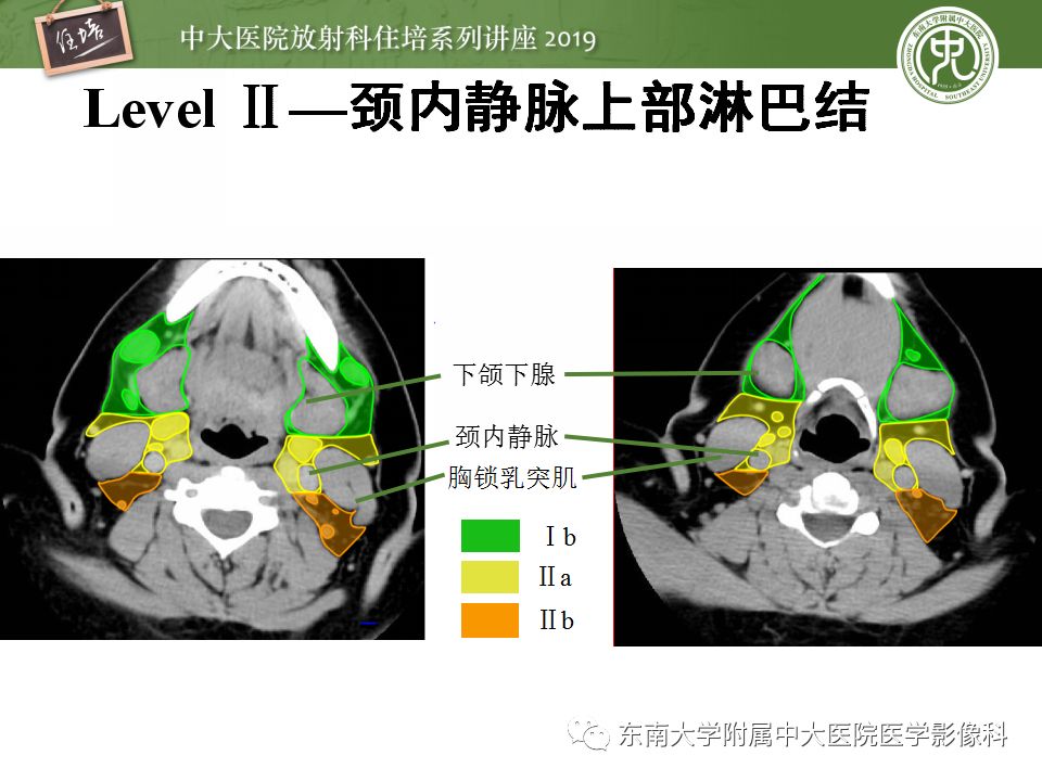 影像PPT - 【PPT】颈部淋巴结的影像解剖及常见病变的影像表现-11