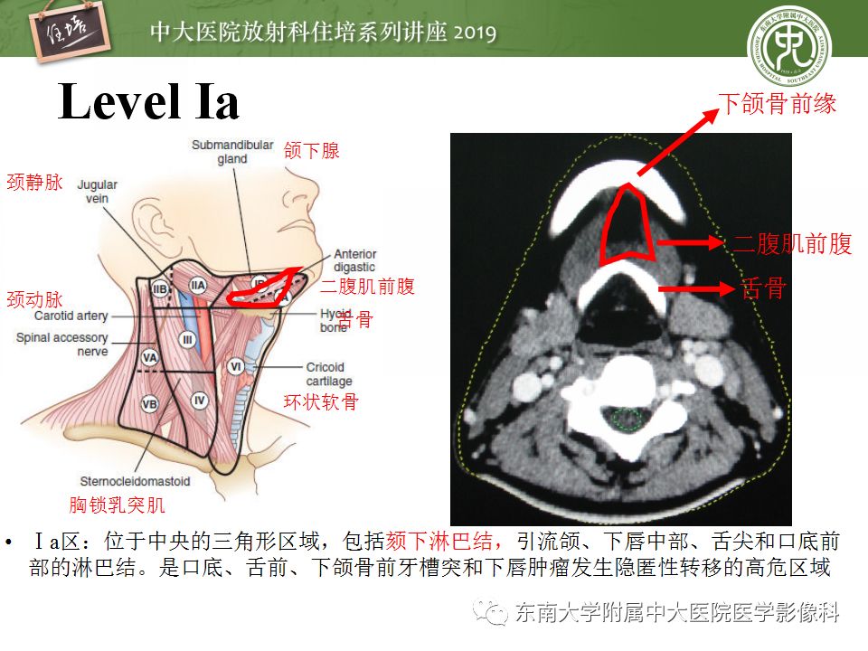 影像PPT - 【PPT】颈部淋巴结的影像解剖及常见病变的影像表现-8