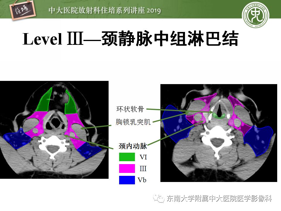 影像PPT - 【PPT】颈部淋巴结的影像解剖及常见病变的影像表现-12