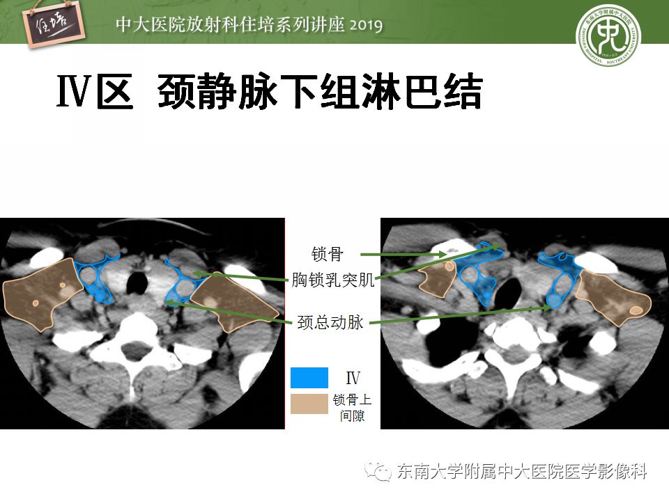 影像PPT - 【PPT】颈部淋巴结的影像解剖及常见病变的影像表现-14