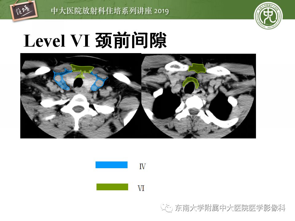 影像PPT - 【PPT】颈部淋巴结的影像解剖及常见病变的影像表现-18
