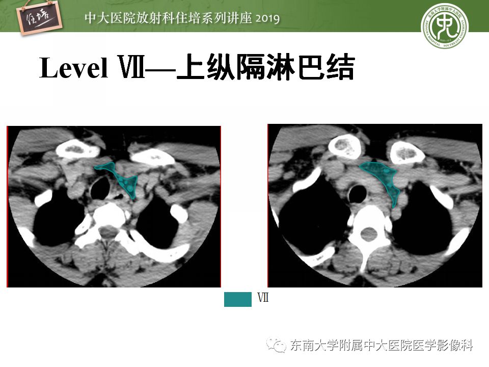 影像PPT - 【PPT】颈部淋巴结的影像解剖及常见病变的影像表现-20