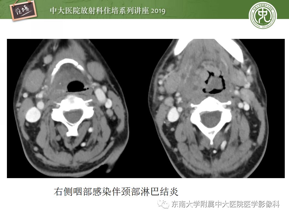 影像PPT - 【PPT】颈部淋巴结的影像解剖及常见病变的影像表现-25