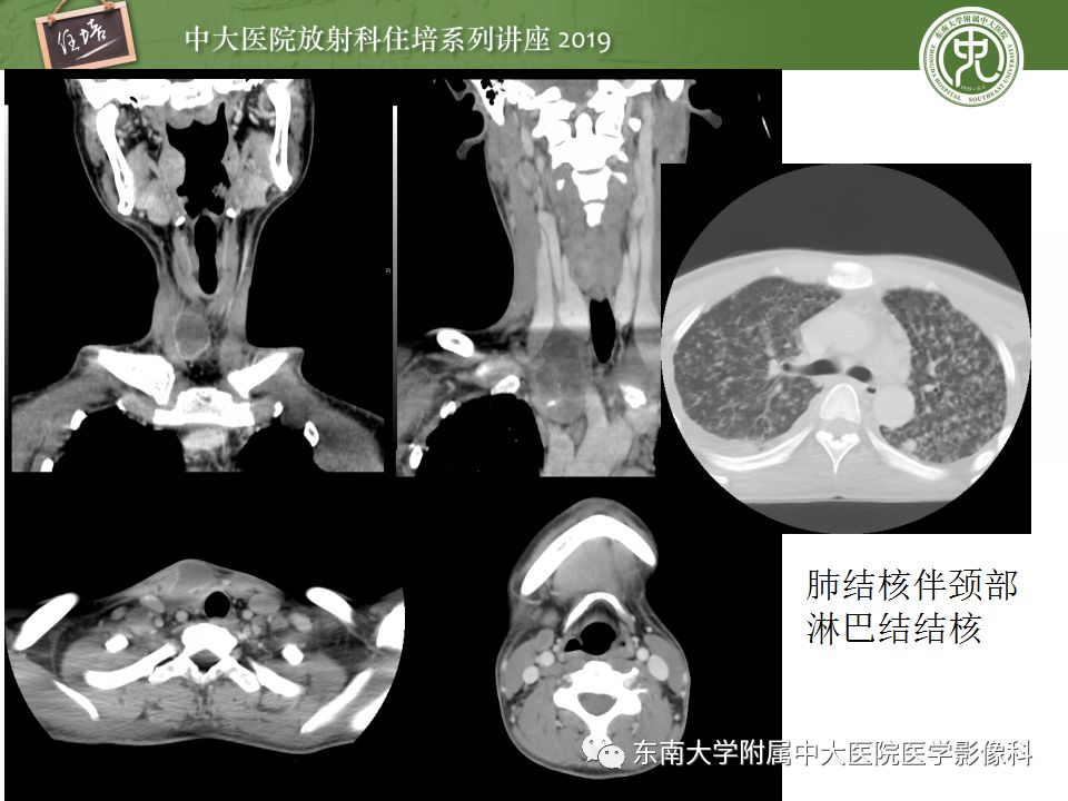 影像PPT - 【PPT】颈部淋巴结的影像解剖及常见病变的影像表现-28