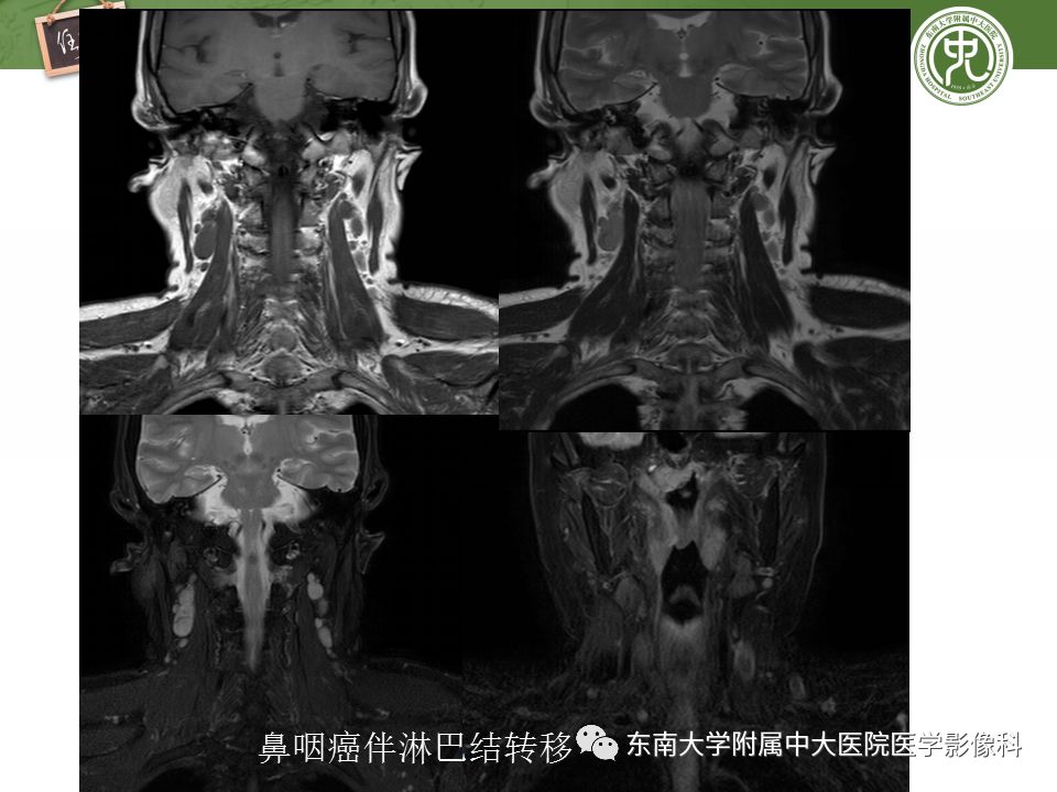 影像PPT - 【PPT】颈部淋巴结的影像解剖及常见病变的影像表现-31