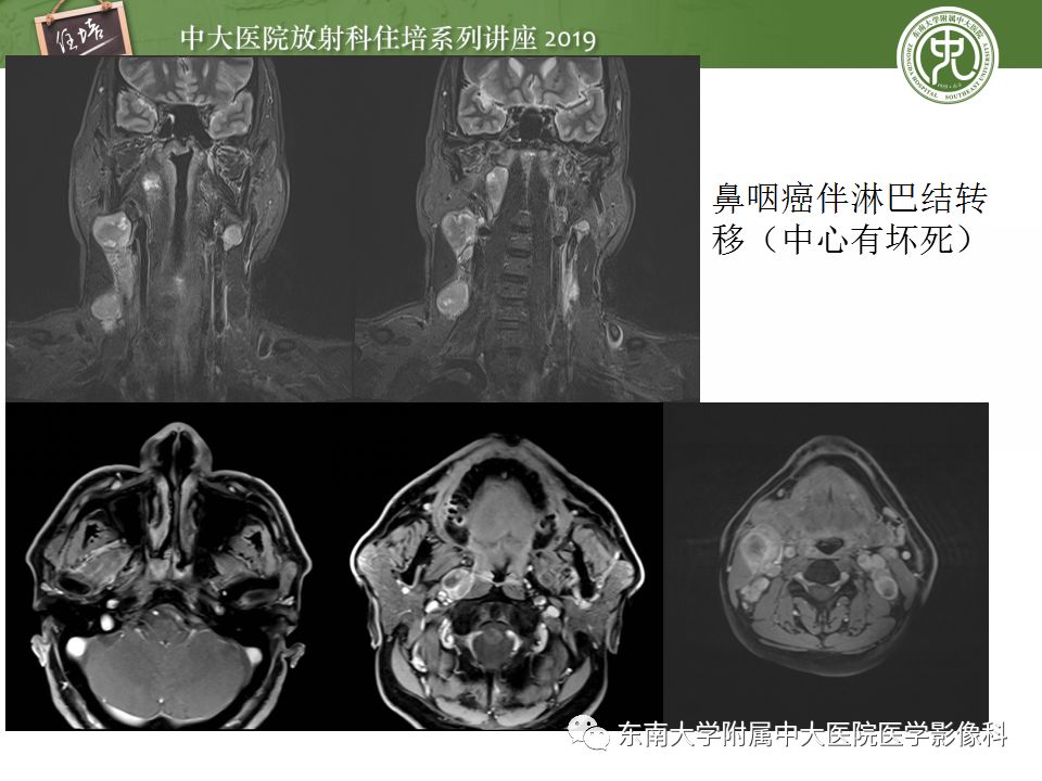 影像PPT - 【PPT】颈部淋巴结的影像解剖及常见病变的影像表现-33