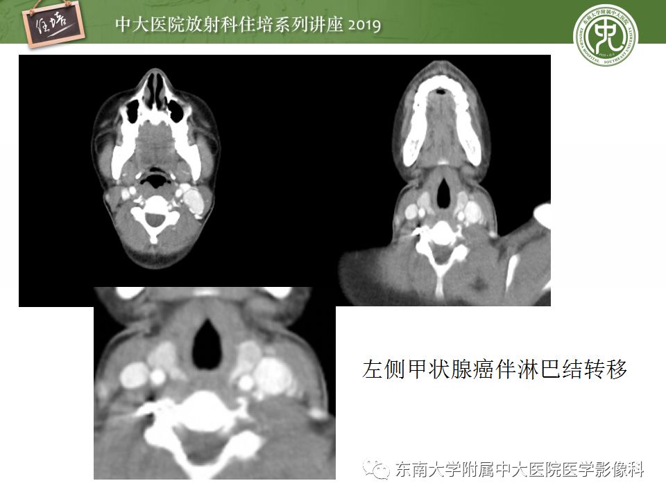 影像PPT - 【PPT】颈部淋巴结的影像解剖及常见病变的影像表现-35