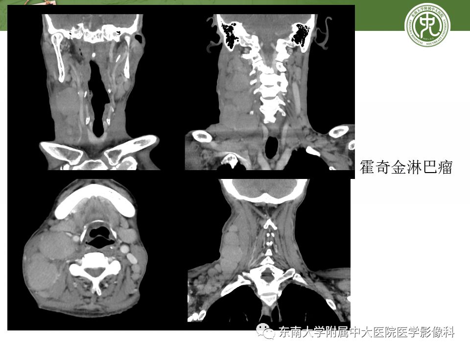 影像PPT - 【PPT】颈部淋巴结的影像解剖及常见病变的影像表现-39