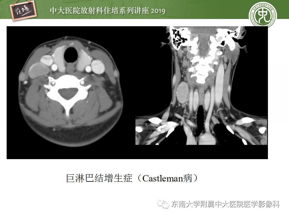 影像PPT - 【PPT】颈部淋巴结的影像解剖及常见病变的影像表现-42