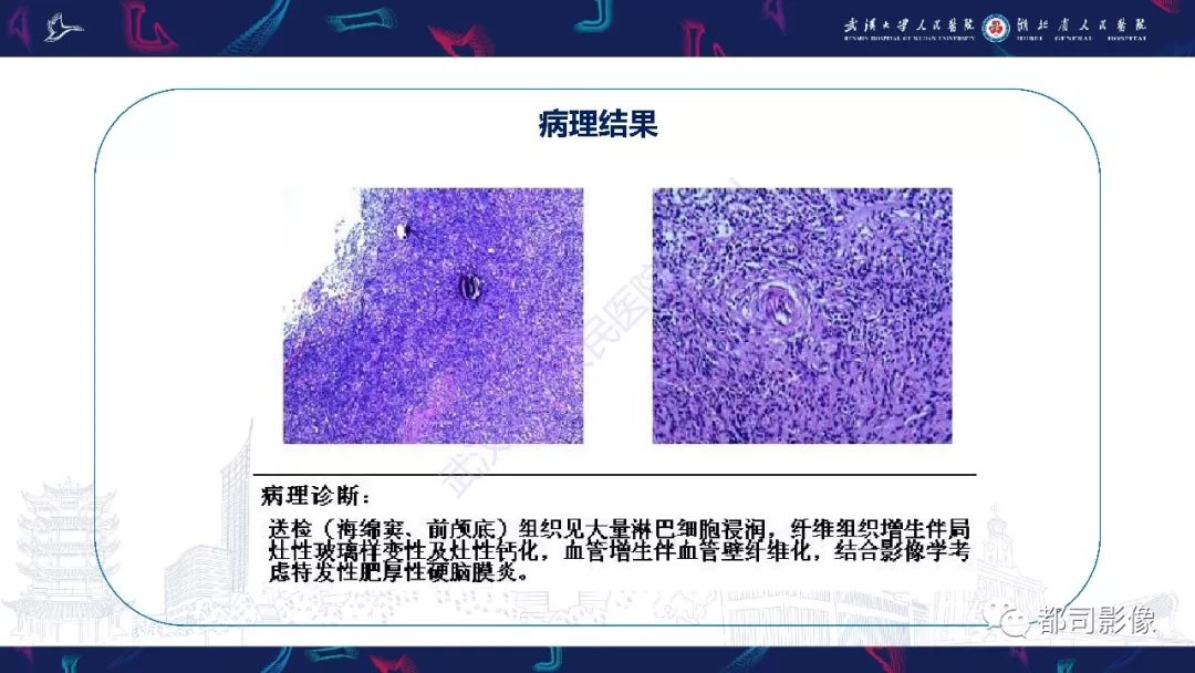 影像PPT - 【PPT】肥厚性硬脑膜炎影像诊断-9