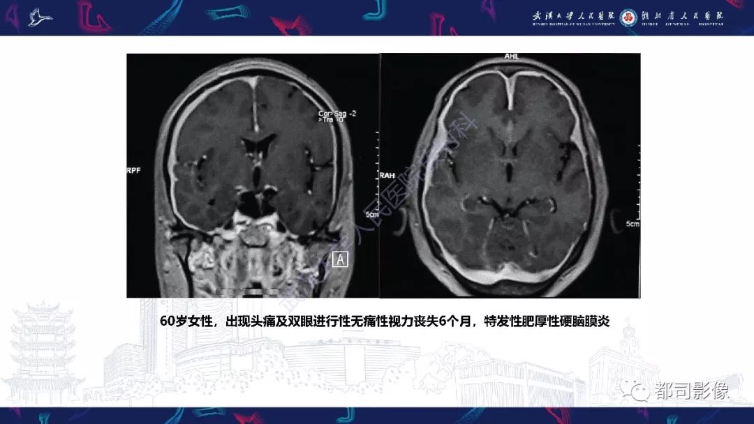 影像PPT - 【PPT】肥厚性硬脑膜炎影像诊断-14