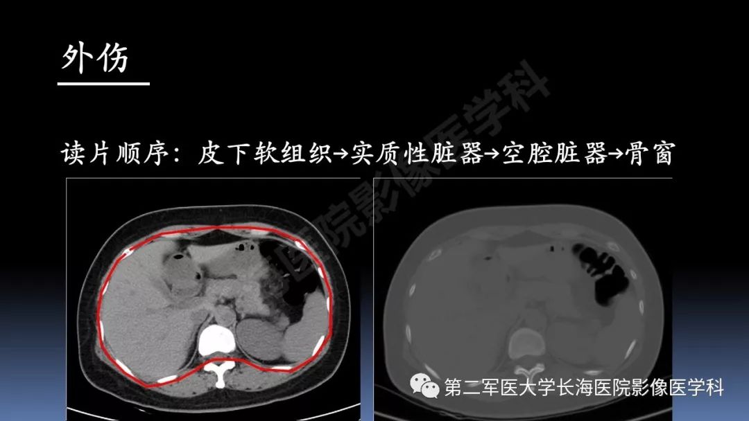 影像PPT - 【PPT】急腹症CT读片思路解析-9