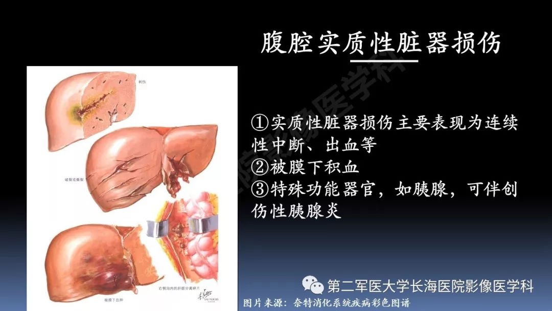 影像PPT - 【PPT】急腹症CT读片思路解析-11