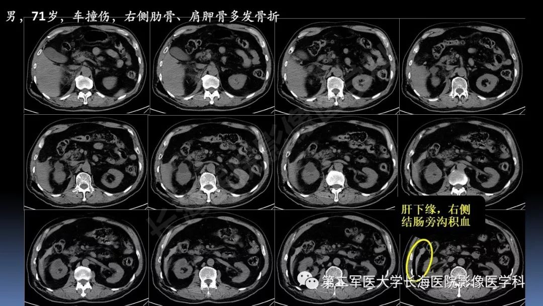影像PPT - 【PPT】急腹症CT读片思路解析-12