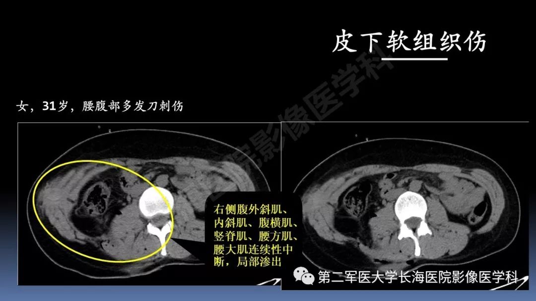 影像PPT - 【PPT】急腹症CT读片思路解析-10