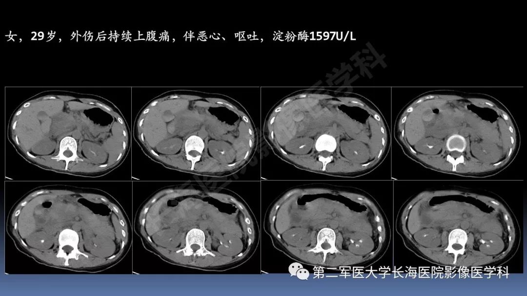 影像PPT - 【PPT】急腹症CT读片思路解析-15