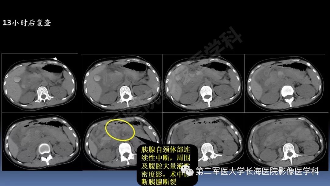 影像PPT - 【PPT】急腹症CT读片思路解析-16