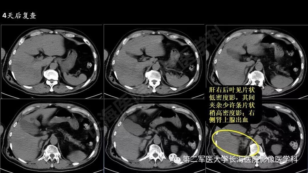 影像PPT - 【PPT】急腹症CT读片思路解析-13