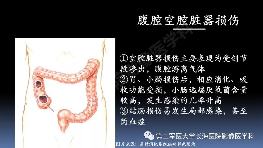 影像PPT - 【PPT】急腹症CT读片思路解析-18