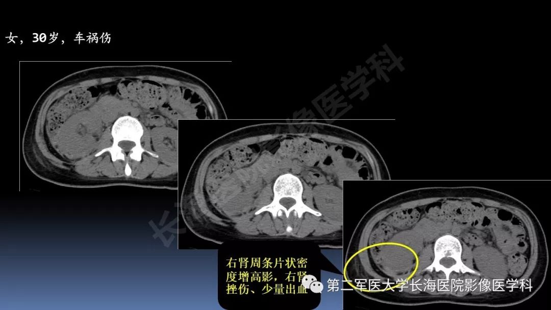 影像PPT - 【PPT】急腹症CT读片思路解析-17