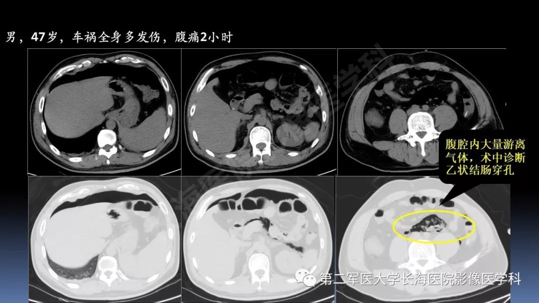 影像PPT - 【PPT】急腹症CT读片思路解析-19