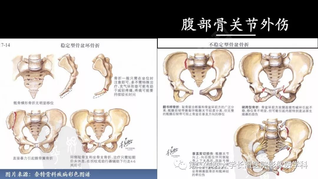 影像PPT - 【PPT】急腹症CT读片思路解析-21