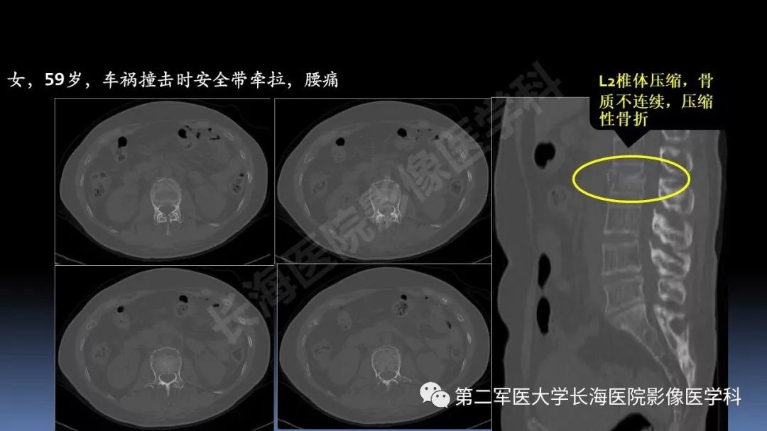 影像PPT - 【PPT】急腹症CT读片思路解析-22