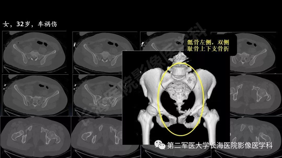 影像PPT - 【PPT】急腹症CT读片思路解析-23