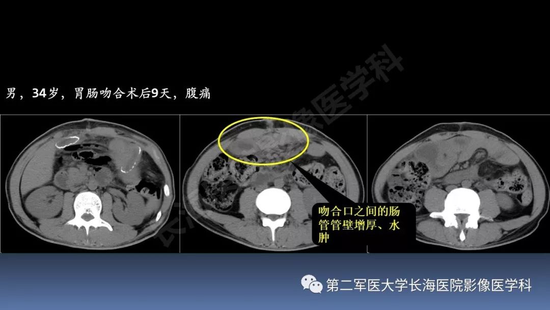影像PPT - 【PPT】急腹症CT读片思路解析-25