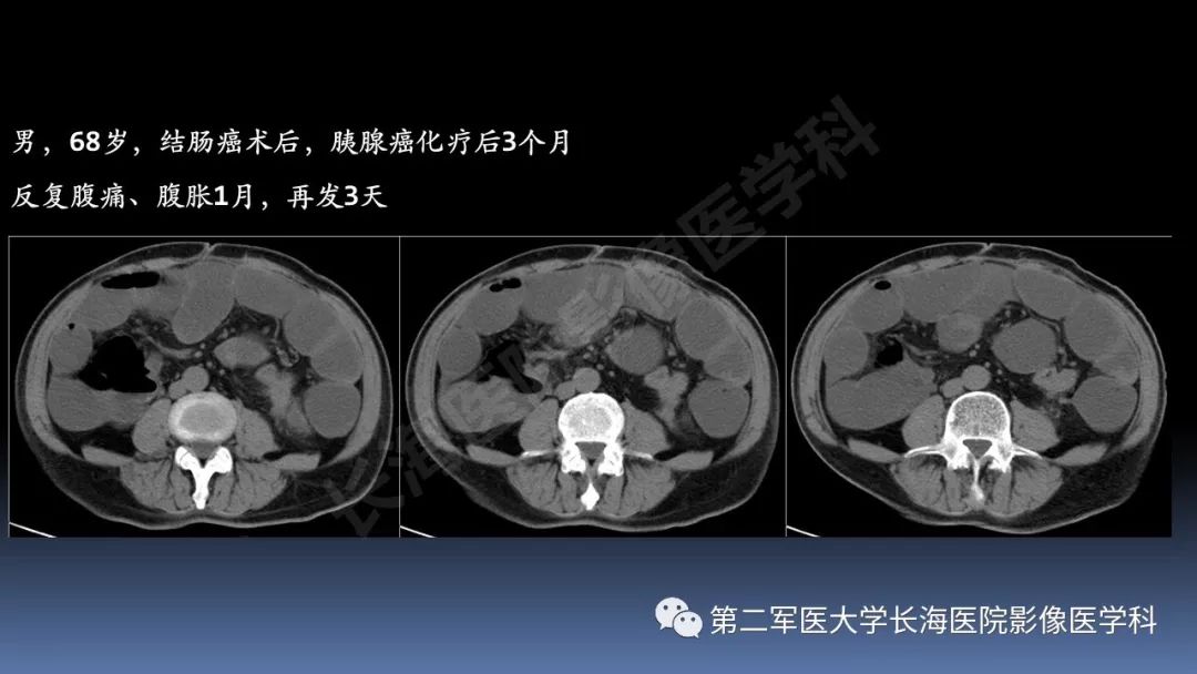 影像PPT - 【PPT】急腹症CT读片思路解析-28